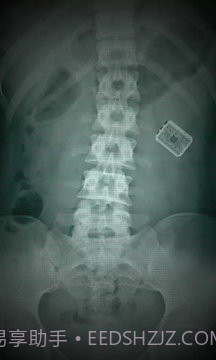 X射线扫描器胃截图3